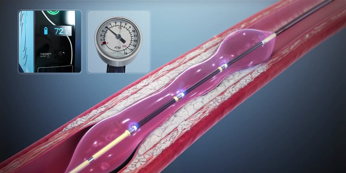 Medical Moment: Shockwave therapy opens clogged arteries