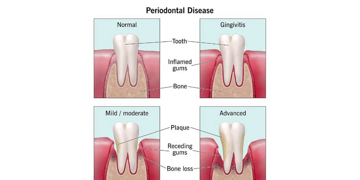 Tooth Later Medical Moment: Catching gum disease early saves teeth later